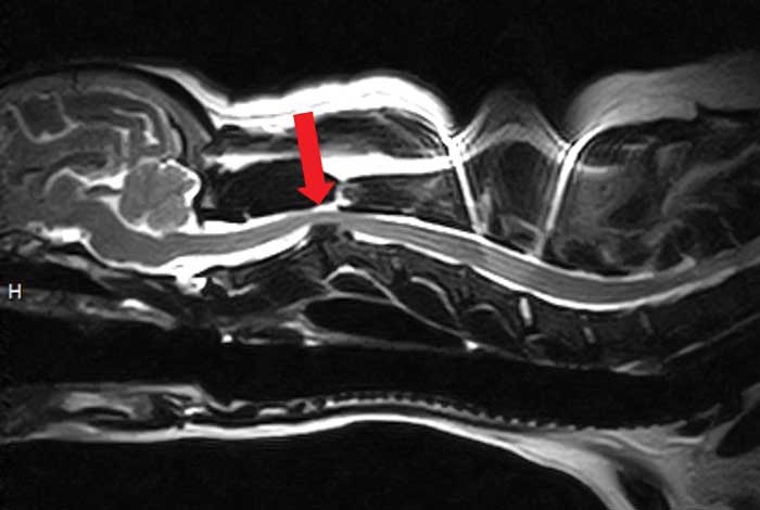 Figure 4. An MRI study of the cervical region of a five-year-old cocker spaniel presented with an acute history of neck pain. This sagittal T2-weighted image reveals a markedly compressive C2 to C3 intervertebral disc extrusion.