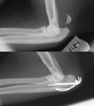 Figure 5. Mediolateral radiographs of a skeletally immature domestic shorthaired cat with a Salter-Harris type one fracture of the proximal ulnar olecranon physis (above). The fracture has been stabilised with two K-wires and a figure-of-eight tension band wire (below).