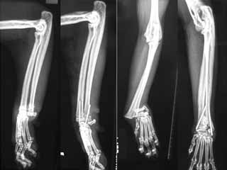 Figure 6. Mediolateral (left) and dorsopalmar (right) radiographs of the antebrachium of a one-year-old domestic shorthair cat with a Salter-Harris type one fracture of the distal radial and ulnar physes. These have been stabilised with two K-wires.