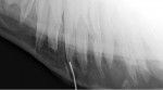 Figure 11. A metallic probe placed in a draining tract, highlighting one of the dental roots.