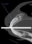 Figure 5. Aiming of the x-ray beam for intra-oral view.