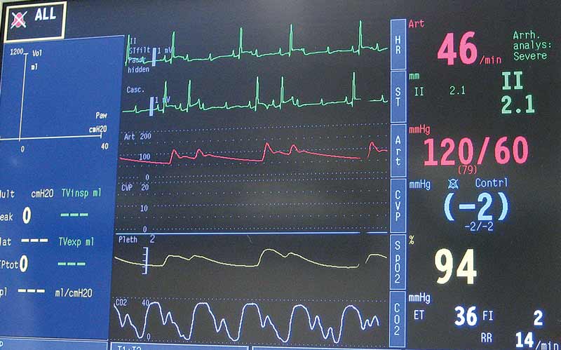 Figure 1. A multiparameter monitor showing second degree atrioventricular blocks.