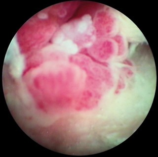 Figure 7. A video-otoscopic image of a cat with an inflammatory polyp.