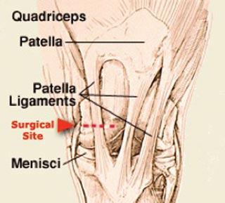 Figure 5. Anatomy of the ligaments of the dorsal aspect of the stifle region showing the location for transection of the medial patellar ligament on the medial aspect of the femoropatellar joint.