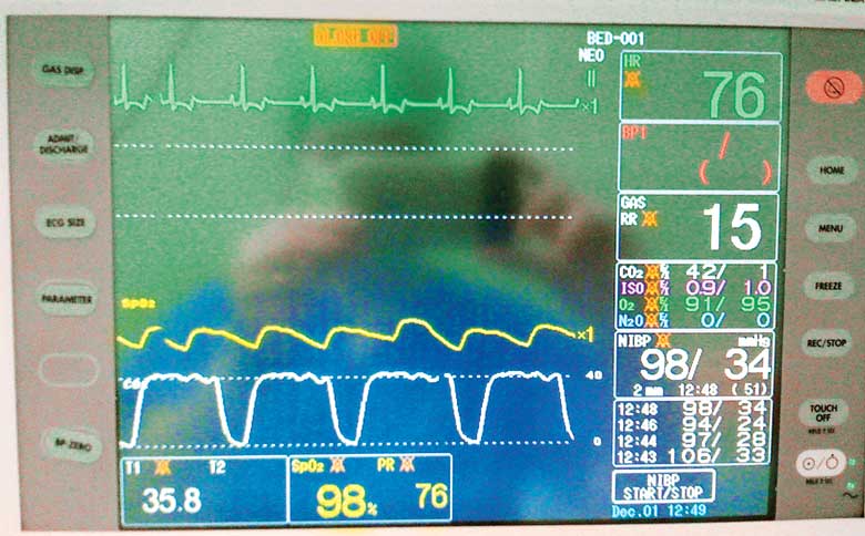 Figure 2. A multiparameter monitor. Note the green ECG trace and heart rate at the top, yellow pulse trace from the pulse oximeter and SpO2 reading and white capnograph trace with ETCO2.