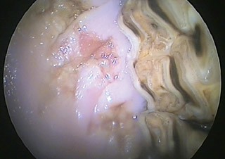 Figure 4. An oral endoscopic view of the cheeks showing buccal lacerations and ulceration caused by sharp enamel overgrowths. 