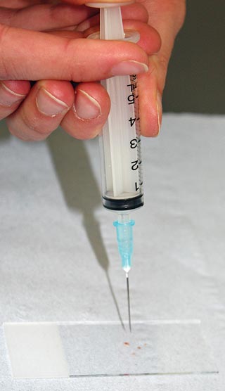 Figure 3. Fine-needle aspiration is cheap and straightforward to do. 