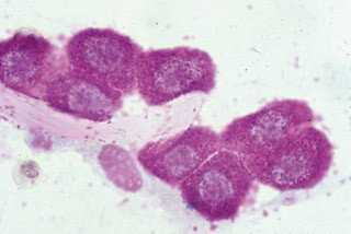 Figure 4. Mast cell tumours exfoliate readily, so a fine needle aspirate should always be considered where one is suspected.