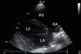 Figure 1. This horse presented with atrial fibrillation and has arrhythmogenic right cardiomyopathy. The echocardiogram shows marked dilation of the right ventricular (RV) lumen, with thickening of the RV walls and right atrial dilation. LV: left ventricle; LA: left atrium; RA: right atrium.