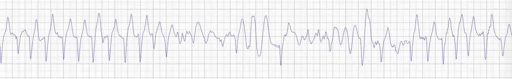 Figure 5. Broad QRS complexes with R-on-T in an ECG recorded during trotting exercise in a Thoroughbred stallion with lone atrial fibrillation. This horse showed no signs of ill health and the dysrhythmia was first detected during a routine physical examination.