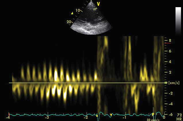 Figure 7. A tissue Doppler echocardiogram documenting movement of the left atrial wall. The atrial fibrillation cycle length is estimated as the time interval between the onset of two consecutive positive atrial deflections. This parameter shows potential as a prognostic indicator.