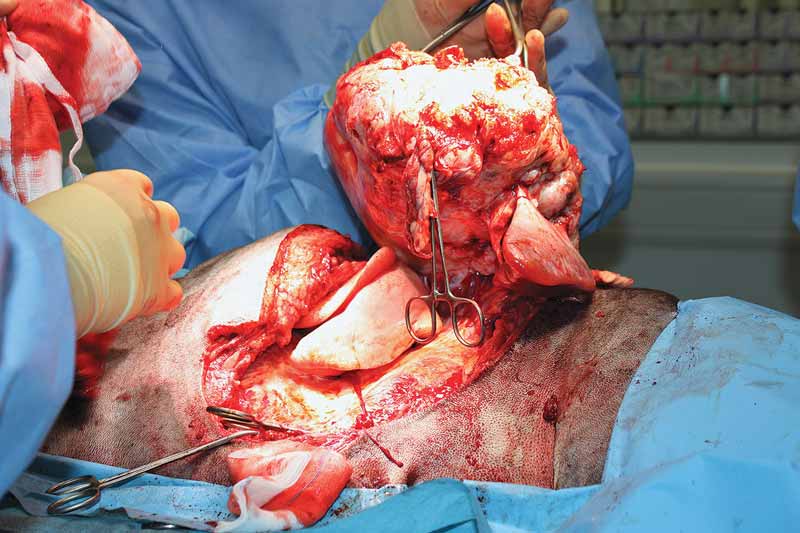 Figure 4. Full thickness thoracic wall resection (in this case, a four-rib portion of thoracic wall incorporating two lung lobectomies due to tumour adhesions) is an example of radical resection.