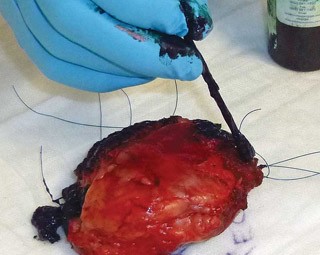 Figure 5. Tissue ink is a useful way of marking the margins of resection after tumour removal. It allows the pathologist to accurately recognise the true margin, regardless of how the tissue is orientated on the slide. Image: Fui Yap.