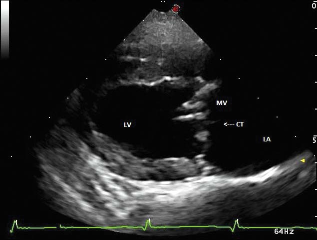 Figure 2. Right parasternal long axis view of a dog with degenerative mitral valve disease. Thickening and prolapse of the mitral valve (bulging of the valve toward the left atrium), marked left atrial enlargement and a small echoic linear structure suggestive of ruptured chordae tendineae are identified.