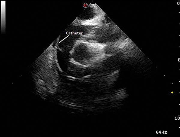 Figure 4b. The retrieval basket can be seen inside the pulmonary artery.