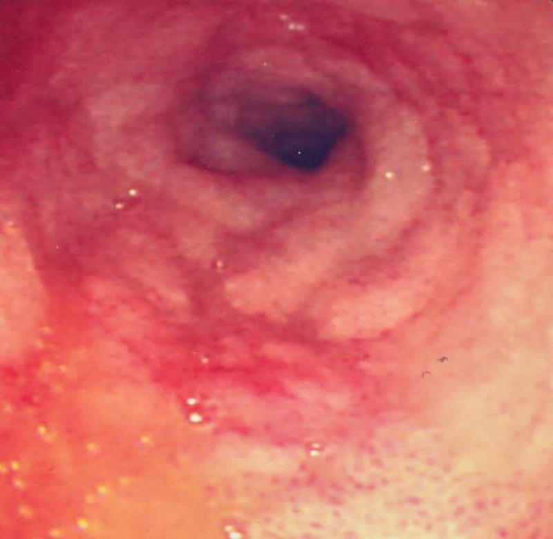 Figure 1. Inflammatory bowel disease in a dog resulting in inflamed intestinal mucosa.