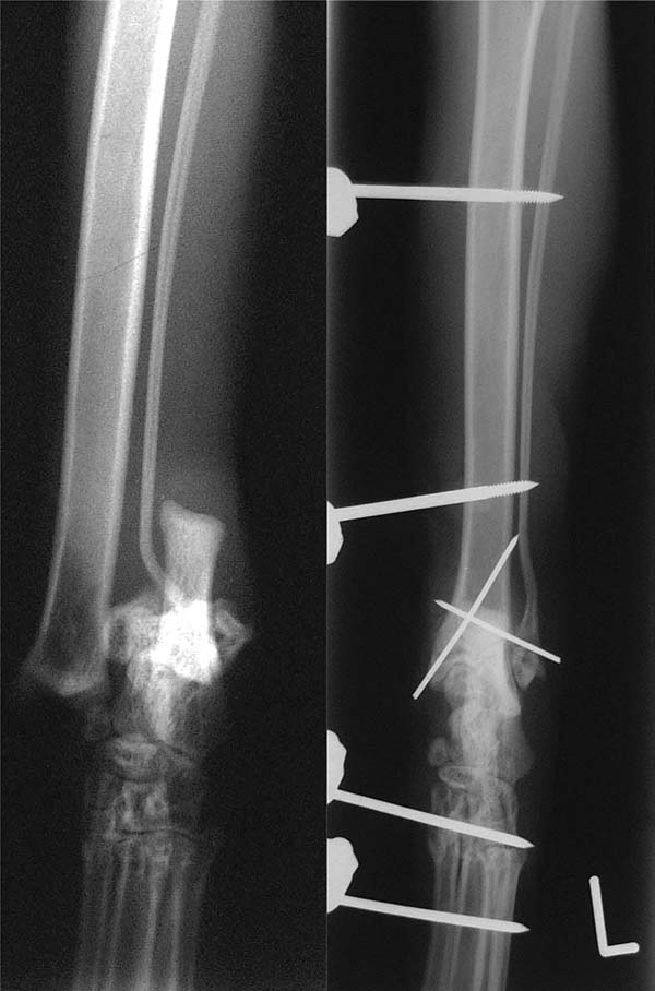 Figure 5. Dorsoplantar radiographs of the tarsus of a skeletally immature domestic shorthaired cat with a Salter-Harris type one fracture of the distal tibia and fracture of the distal fibula (left). The fractures have been stabilised with crossed Kirschner wires and a transarticular external skeletal fixator (right).