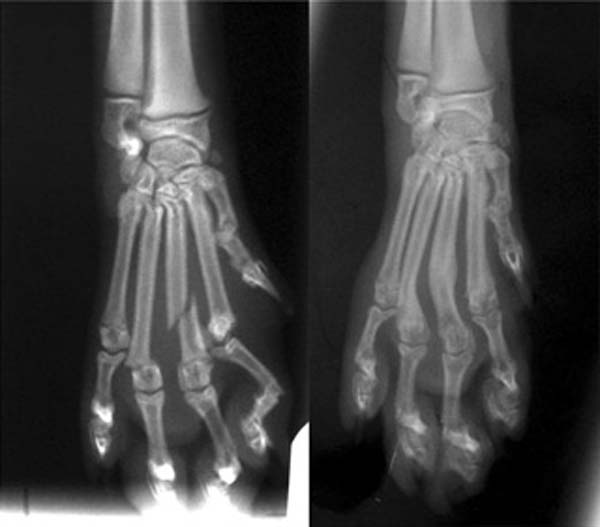 Figure 6. Dorsopalmar radiographs of the manus of a skeletally immature crossbreed dog. Multiple metacarpal fractures are present, including a Salter-Harris type one fracture of distal metacarpal IV (left). The fractures went on to complete union with external coaptation (right).