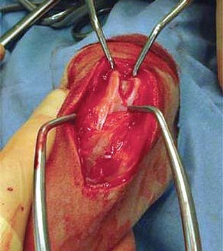 Figure 1. Intraoperative photograph demonstrating a trochlear wedge recession in a four-year-old cavalier King Charles spaniel.