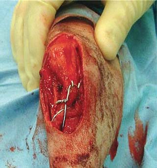Figure 2. Intraoperative photograph demonstrating a lateral tibial tuberosity in a four-year-old cavalier King Charles spaniel stabilised using two Kirschner wires and a tension band wire.
