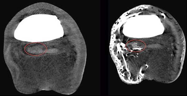 Figure 3. Pre-contrast and post-contrast image of the deep digital flexor tendon with associated proliferation of the axial margin of the lobe. The lobe has marked centrally located contrast enhancement, indicating an extensive and active lesion.