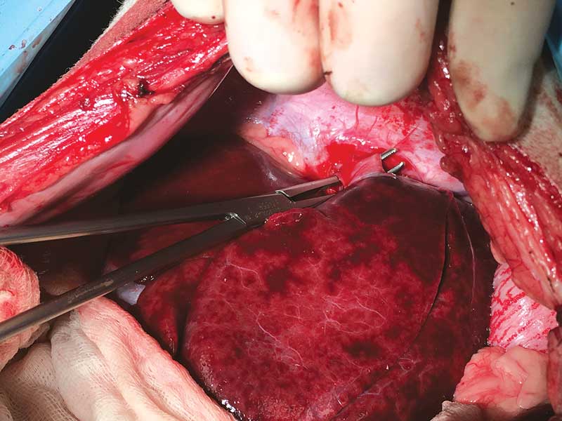 Figure 1. An intrahepatic shunt. 