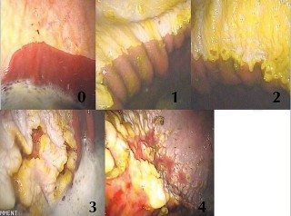 Figure 4. The grades of equine squamous gastric disease, rated from zero to four.