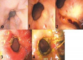 Figure 5. Grades of equine glandular gastric disease, rated from zero to four.