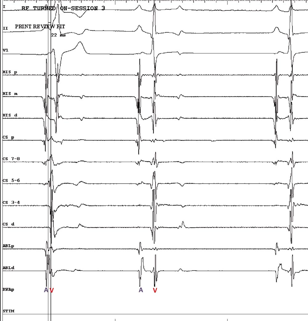 Figure 4. Intracardiac ECGs at the moment of ablation. The waves marked “A” indicate atrial activation and those marked “V” indicate ventricular activation. Since the ablation catheter is positioned exactly on top of the pathway, these two waves are seen happening simultaneously on the first beat as the impulse travels through the pathway from the atrium to the ventricle at this point. After ablation (second beat) these waves are separated as the impulse is no longer able to travel through the pathway.