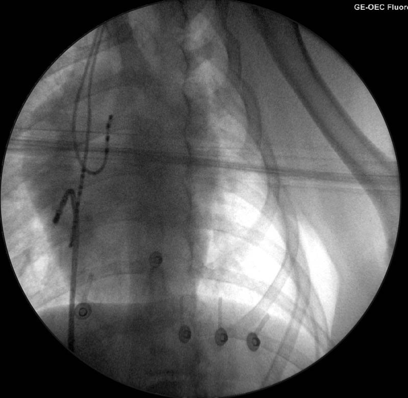 Figure 3b. Fluoroscopy image showing the catheters inside the heart.