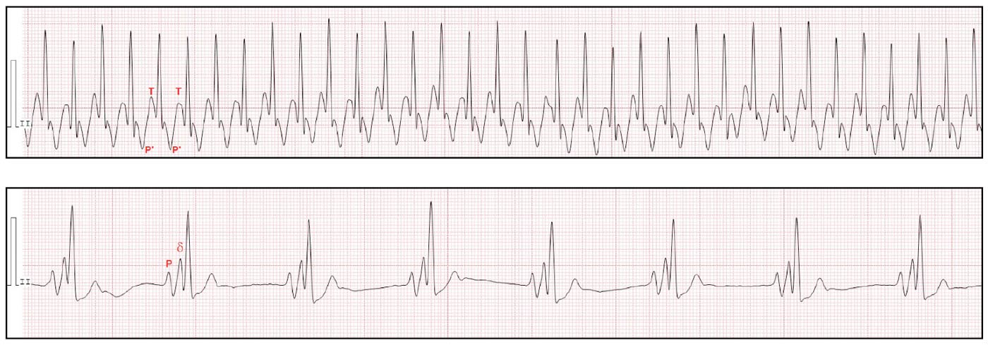 Figure 2a. ECG (50mm/mV, 20mm/mV). Tachycardia (360bpm) with normal-looking (narrow) QRS complexes indicates the presence of a supraventricular tachycardia. Normal P waves are not seen and instead small negative deflections at the level of the ST segment suggest retroconducted P waves after the QRS complex. These findings suggest orthodromic atrioventricular reciprocating tachycardia. Figure 2b. Sinus rhythm. The PR interval is short and a small positive deflection is seen between the P wave and QRS (δ wave) suggesting pre-excitation via an accessory pathway.