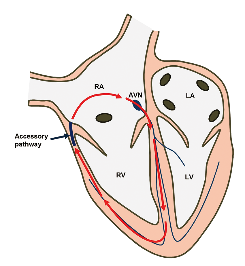 Figure 1. Orthodromic atrioventricular reciprocating tachycardia. Imagine an impulse travelling down normally through the atrioventricular node (AVN), His-Purkinje system and ventricles, creating a QRS complex on the ECG. When the accessory pathway is reached, this impulse is able to travel back to the atrium creating a negative P wave on the ECG just after the QRS. The impulse travels down again via the AVN and ventricles and up the accessory pathway, repeatedly leading to tachycardia.