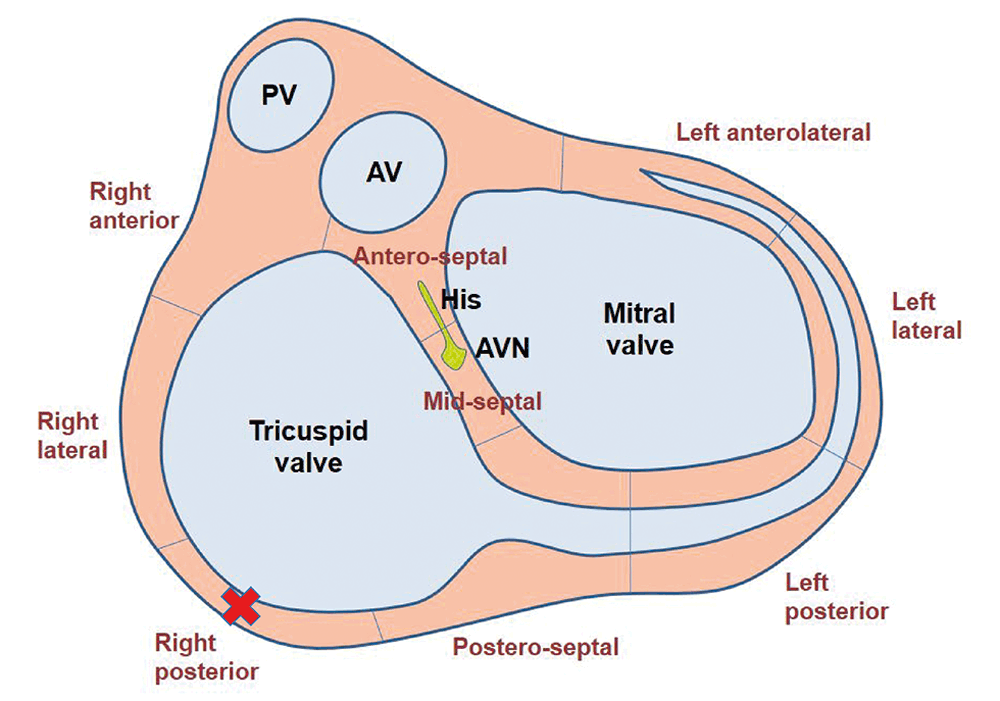 Figure 3a. Position of the accessory pathway.