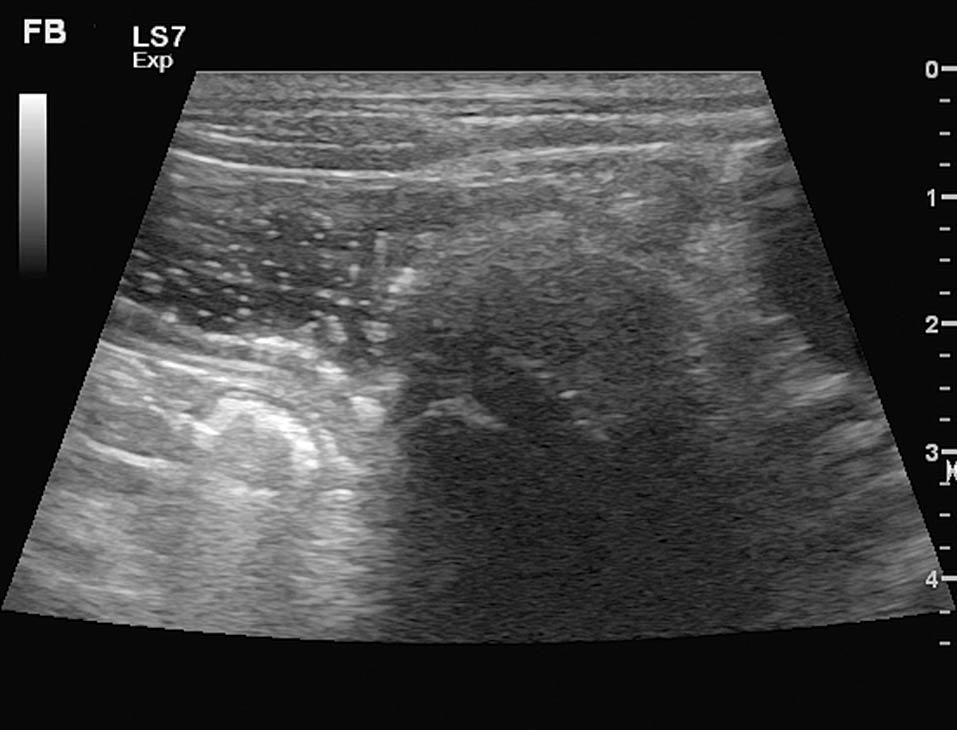 Figure 2. Abdominal ultrasonography of a one-year-old west Highland white terrier demonstrating an ovoid foreign body in the distal duodenum, with mechanical ileus and duodenal distension proximal to the foreign body. Hyperechogenicity of the surrounding mesenteric fat and shadowing artefact created by the foreign body is also visible.