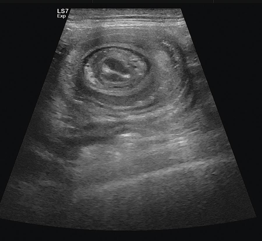 Figure 3. Abdominal ultrasonography of a six-year-old flat-coated retriever demonstrating a jejuno-jejunal intussusception. Part of the jejunal wall was thickened, especially on the external loops. Surgical resection was performed and histopathology revealed leiomyosarcoma of the jejunal wall.