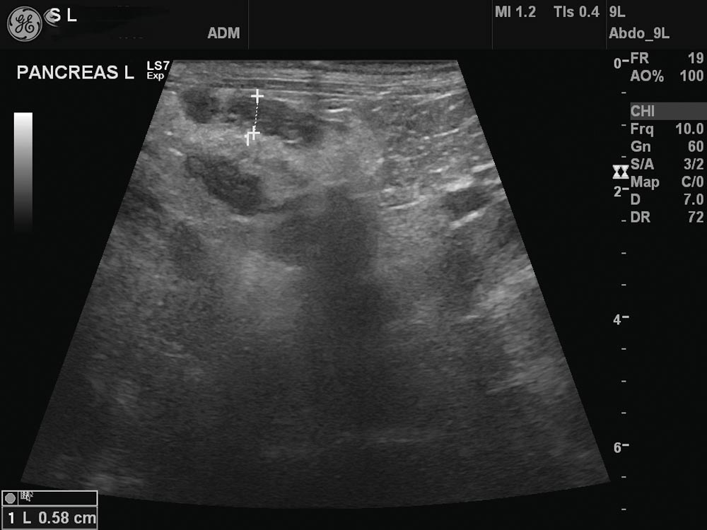 Figure 4. Abdominal ultrasonography of a six-year-old Tibetan terrier demonstrating the pancreas to be swollen and hypoechoic, and the surrounding fat to be hyperechoic, consistent with acute pancreatitis.