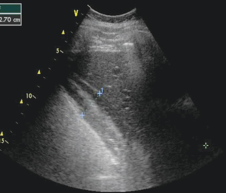 Figure 1. A thickened caecal wall consistent with oedema in a case that presented with weight loss, recurrent colic and diarrhoea. 