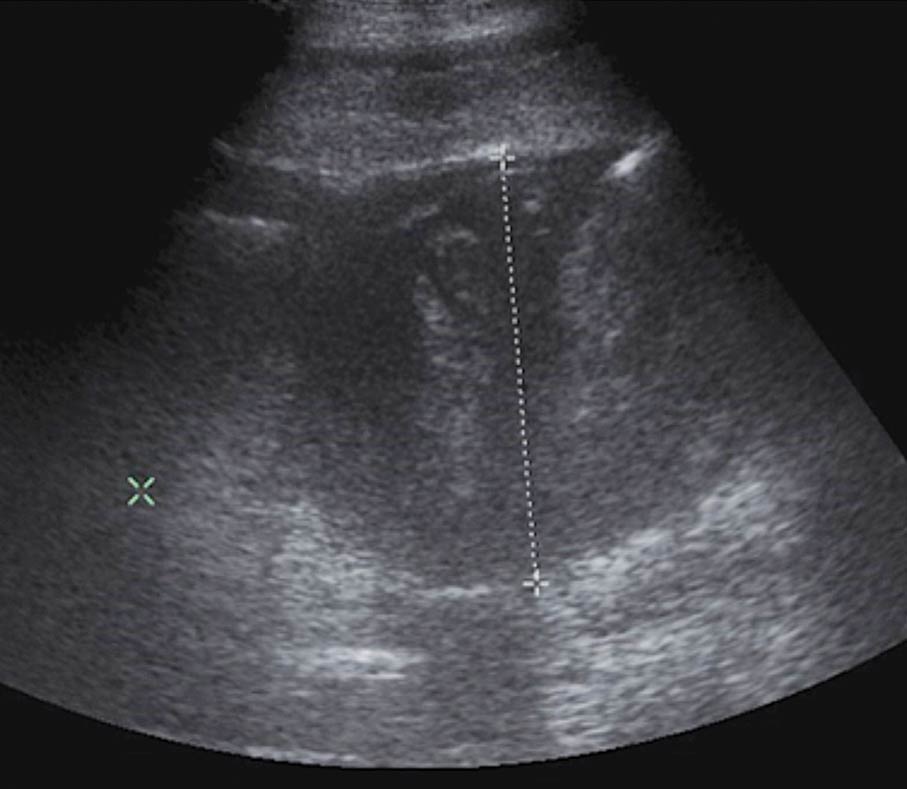 Figure 2. A ventral midline abdominal abscess, imaged with ultrasound and confirmed at exploratory laparotomy, in a horse presenting with recurrent colic, pyrexia and weight loss.