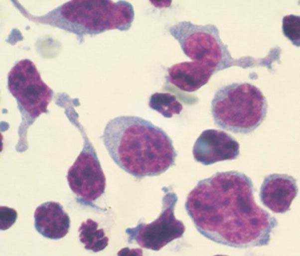 Figure 3. Peritoneal fluid with abnormal lymphocytes consistent with gastrointestinal lymphoma. The horse was presented with weight loss, recurrent colic and diarrhoea. Image: Harold Tvedten.