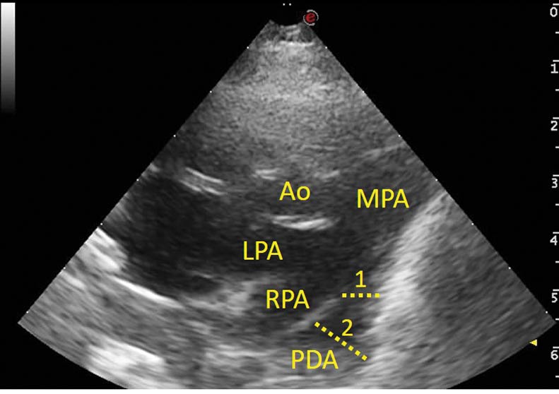 short axis view at the level of the pulmonary artery. 1 shows the area of the ductus ostium measuring between 4.5mm and 5mm. 2 shows the ductus ampulla diameter measuring 10mm. Ao: aorta, LPA: left pulmonary artery, MPA: main pulmonary artery, PDA: patent ductus arteriosus, RPA: right pulmonary artery.