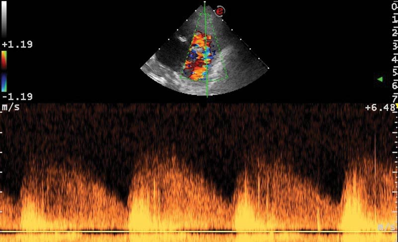 Figure 2. Continuous pulsed-wave Doppler on the right parasternal short axis view at the level of the pulmonary artery showing a high velocity flow through the patent ductus arteriosus communicating the descending aorta with the pulmonary artery.