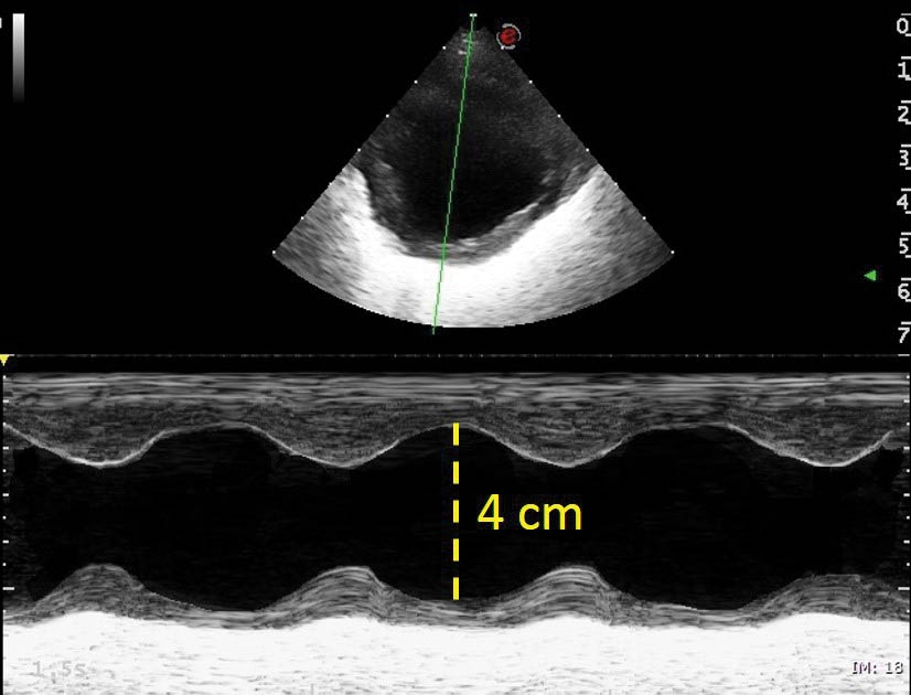 Figure 3. M-mode obtained from the right parasternal short axis view at the level of the papillary muscles showing a hyperdynamic and dilated left ventricle. Fractional shortening 48% (reference greater than 25%).