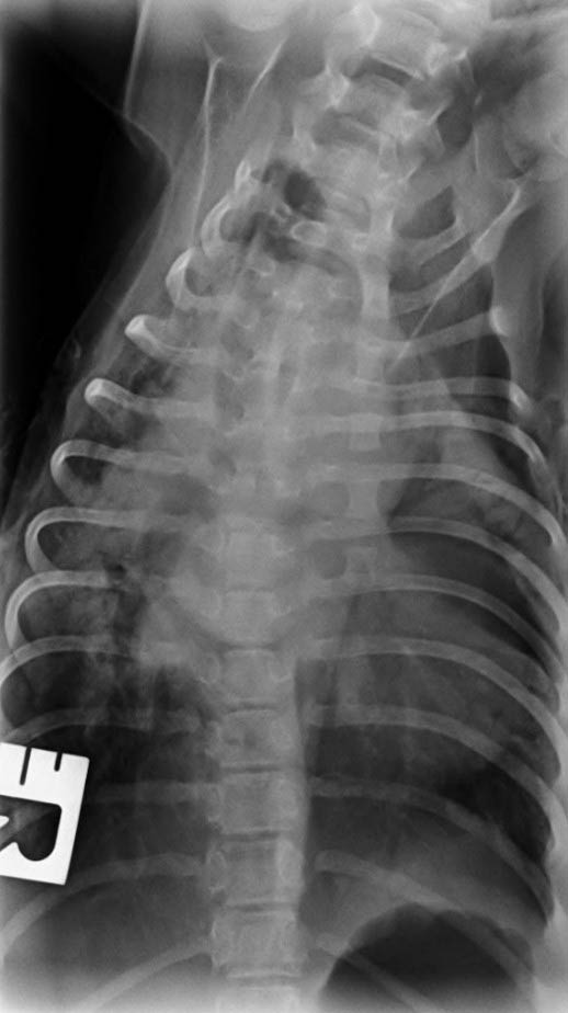 Figure 4. Unsedated dorsoventral radiograph of the thorax showing marked cardiomegaly, diffused interstitial pattern effacing the margins of the cardiac silhouette, presence of air bronchograms on the perihilar region extending towards the right side of the chest and separation of the main stem bronchi due to dilation of the left atrium (also known as “cowboy legs” sign).