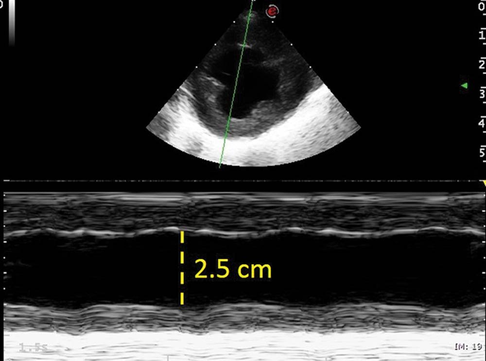 Figure 6. M-mode obtained from the right parasternal short axis view at the level of the papillary muscles showing and hypodynamic left ventricle. Fractional shortening 20% (reference greater than 25%).