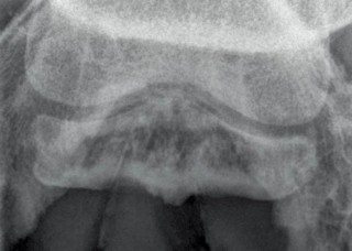 Palmar-proximal to palmar-distal oblique radiographic view of the navicular bone of the horse that suffered distal interphalangeal joints luxation. While there is clearly medullary sclerosis and areas of lysis within the navicular bone, there is also marked irregularity of the flexor cortex associated with fibrocartilage erosion. There was also marked calcification of the navicular suspensory apparatus. This is a severe case of “navicular syndrome” or palmar/plantar foot pain/podotrochlear apparatus syndrome.
