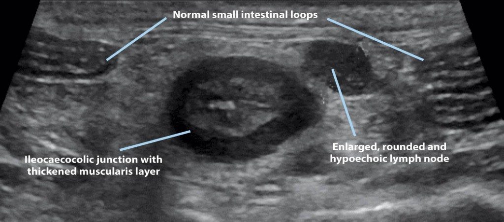 Figure 2. Ultrasonographic view of the ileocaecocolic junction, small intestinal loops and one of the abdominal lymph nodes in a four-year-old cat with alimentary lymphoma. Note the thickened muscularis layer of the junction compared to the layering of a normal small intestinal loop.