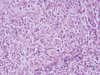 Figure 1. Haematoxylin and eosin (H and E) section of poorly differentiated histiocytic sarcoma. Neoplastic cells are pleomorphic admixed with large numbers of lymphocytes (H and E).