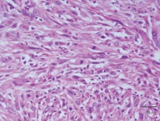 Figure 2. H and E section of spindle cell variant – histiocytic sarcoma, spindle cell subtype. Neoplastic cells are spindle to round with moderate amount of cytoplasm. Mitotic figures are present (H and E).