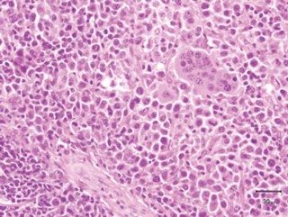 Figure 5. Haematoxylin and eosin (H and E) section of histiocytic subtype. Histiocytic sarcoma, histiocytic subtype with large round neoplastic histocytic cells with some multinucleated giant cells and scattered lymphocytes (H and E).