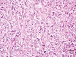 Figure 6. Haematoxylin and eosin (H and E) section of histiocytic-spindle-pleomorphic subtype. Histiocytic sarcoma, histiocytic-spindle-pleomorphic subtype with few fibroblast-like cells admixed with neoplastic histiocytic cells, with a pale eosinophilic cytoplasm (H and E).
